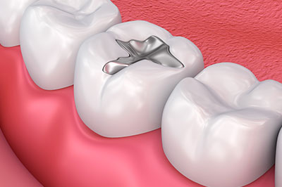 Bethesda Rock Dental | Dental Fillings, Oral Cancer Screening and Night Guards