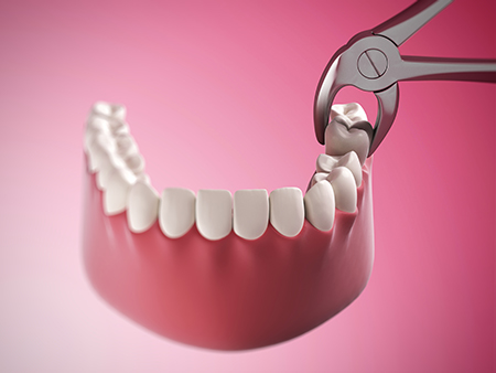 Bethesda Rock Dental | Simple Extractions, Dental Fillings and Dentures