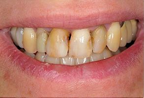 Bethesda Rock Dental | Ceramic Crowns, Emergency Treatment and Pediatric Dentistry
